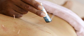 home – treatments – acupuncture – small treatment by acupuncture and moxa